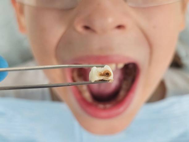 Best Emergency Dentist for Lost Fillings or Crowns in Buzzards Bay, MA